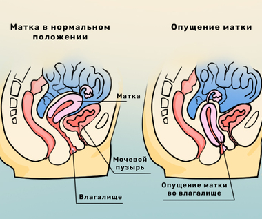 Опущение матки